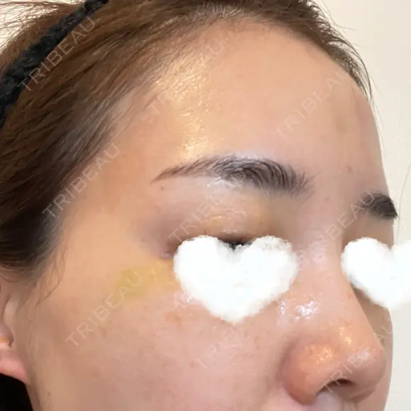 フォトRF / 光治療（フォトフェイシャルなど） 湘南美容クリニック 岡山院 DAY 6 メイン用
