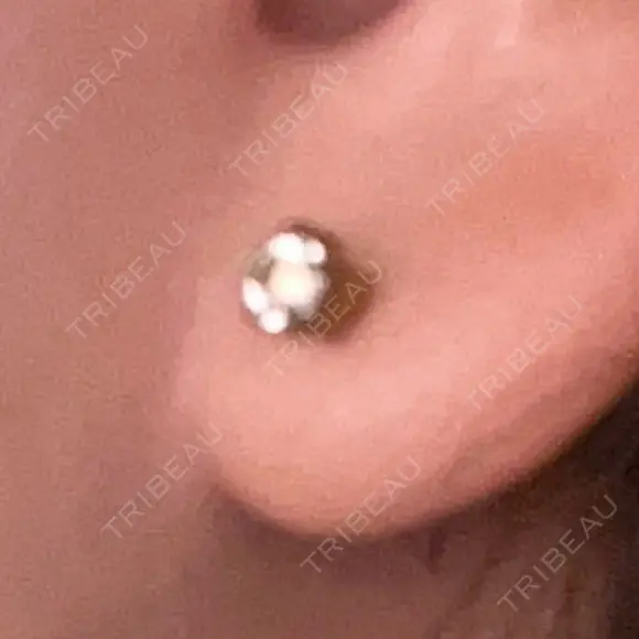 ピアス穴あけ 渋谷美容外科クリニック 渋谷院 DAY 56 メイン用