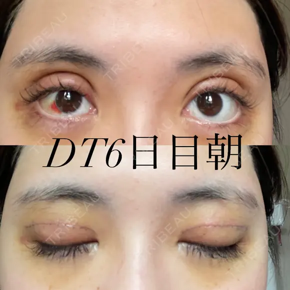 二重切開 / 上まぶたの脂肪取り オーキッド美容クリニック東京御徒町 DAY 6 メイン用