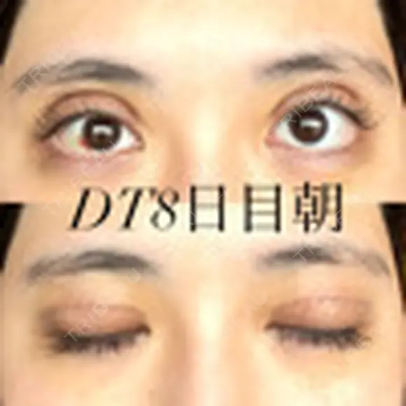 二重切開 / 上まぶたの脂肪取り オーキッド美容クリニック東京御徒町 DAY 8 メイン用