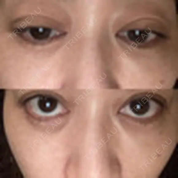 二重埋没 EMMO FACE CLINIC 大宮院 DAY 10 メイン用