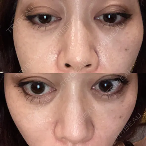 二重埋没 EMMO FACE CLINIC 大宮院 DAY 11 メイン用