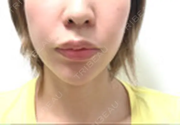 肌ヒアルロン酸注入（たるみ・シワ改善） STARS CLINIC DAY 8 メイン用