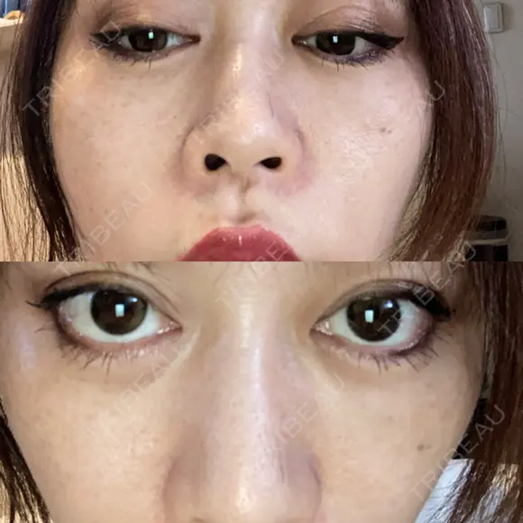 二重埋没 EMMO FACE CLINIC 大宮院 DAY 12 メイン用