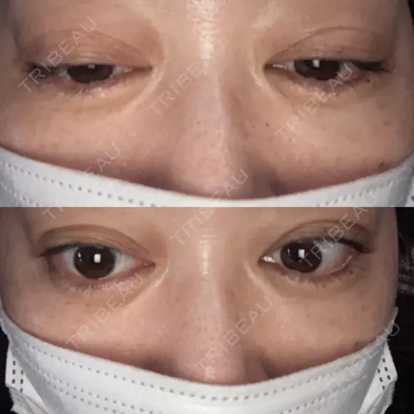 二重埋没 EMMO FACE CLINIC 大宮院 DAY 13 メイン用