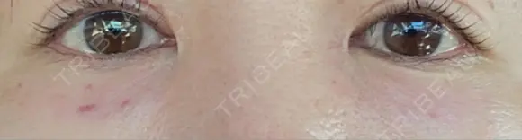 リジュラン 湘南美容クリニック 岡山院 DAY 2 メイン用