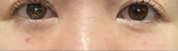 リジュラン 湘南美容クリニック 岡山院 DAY 3 メイン用