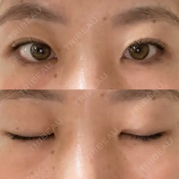 二重埋没 R.O.clinic AFTER メイン用