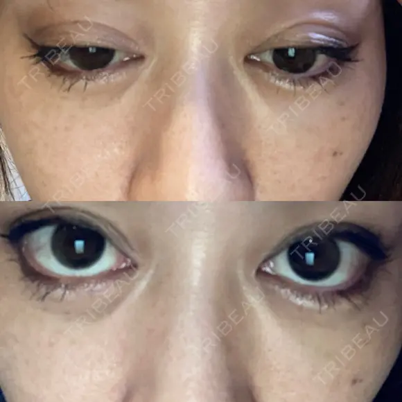 二重埋没 EMMO FACE CLINIC 大宮院 AFTER メイン用