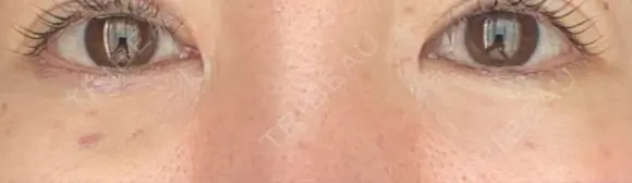 リジュラン 湘南美容クリニック 岡山院 DAY 4 メイン用