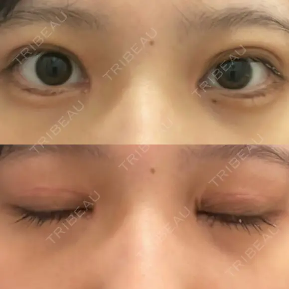 二重切開 / 目頭切開 / クマ治療 / 上まぶたの脂肪取り / 下まぶたの脂肪取り / タレ目形成・グラマラスライン（切開） BRIGHTS beauty clinic DAY 24 メイン用