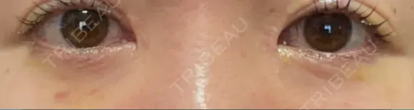 リジュラン 湘南美容クリニック 岡山院 DAY 5 メイン用