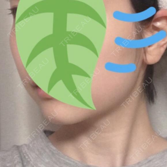脂肪溶解注射（顔） / ハイフ（顔） リエンジャン整形外科 江南店 DAY 11 メイン用