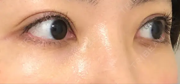 二重切開 / 眼瞼下垂（切開） / 目元修正 トップフェイス整形外科 DAY 129 メイン用