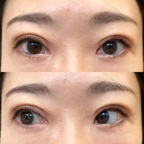 二重切開 / 上まぶたたるみ取り / PRP皮膚再生療法 BRIGHTS beauty clinic DAY 40 メイン用