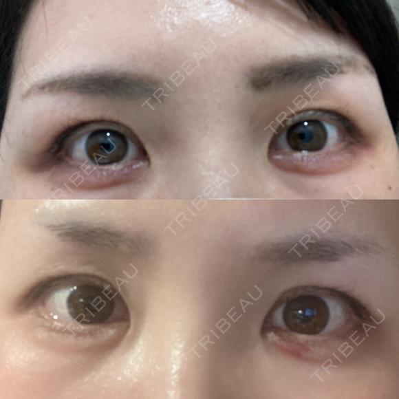 ヒアルロン酸注入（涙袋） TCB東京中央美容外科 金沢院 AFTER メイン用