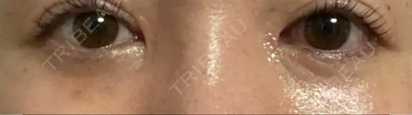 リジュラン 湘南美容クリニック 岡山院 DAY 6 メイン用