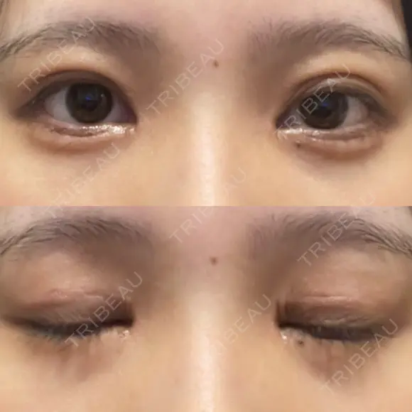 二重切開 / 目頭切開 / クマ治療 / 上まぶたの脂肪取り / 下まぶたの脂肪取り / タレ目形成・グラマラスライン（切開） BRIGHTS beauty clinic DAY 28 メイン用