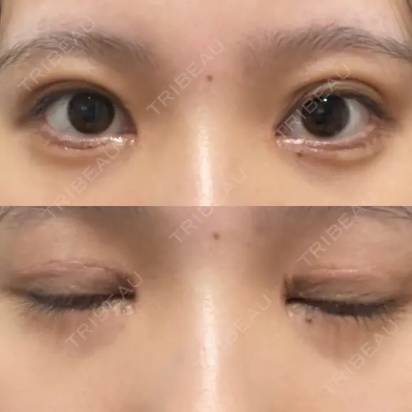 二重切開 / 目頭切開 / クマ治療 / 上まぶたの脂肪取り / 下まぶたの脂肪取り / タレ目形成・グラマラスライン（切開） BRIGHTS beauty clinic DAY 29 メイン用