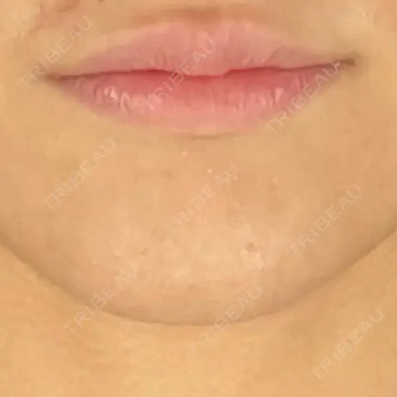 ヒアルロン酸注入（唇） / ボトックス（口角） / ボトックス（目尻） / その他（目元） TCB東京中央美容外科 高崎院 DAY 4 メイン用