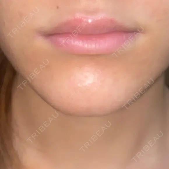 ヒアルロン酸注入（唇） / ボトックス（口角） / ボトックス（目尻） / その他（目元） TCB東京中央美容外科 高崎院 DAY 0 メイン用