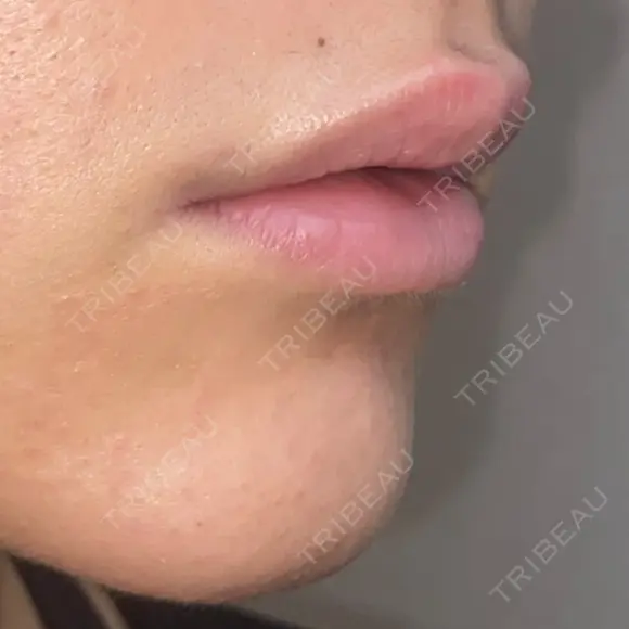 ヒアルロン酸注入（唇） / ボトックス（口角） / ボトックス（目尻） / その他（目元） TCB東京中央美容外科 高崎院 DAY 0 メイン用