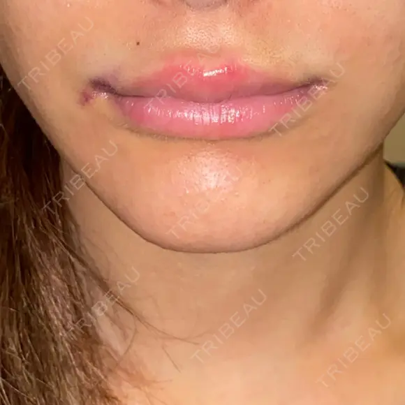 ヒアルロン酸注入（唇） / ボトックス（口角） / ボトックス（目尻） / その他（目元） TCB東京中央美容外科 高崎院 DAY 0 メイン用