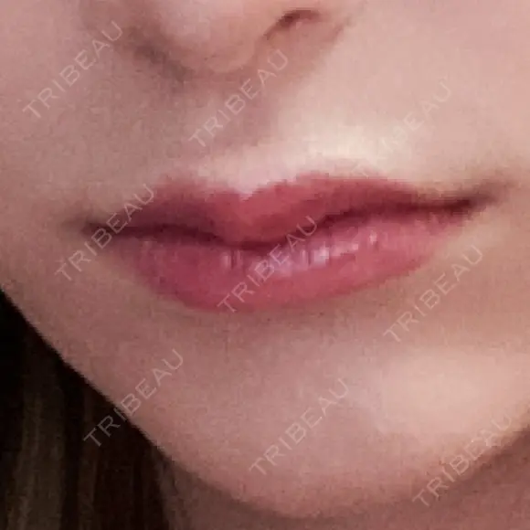 ヒアルロン酸注入（唇） / ボトックス（口角） / ボトックス（目尻） / その他（目元） TCB東京中央美容外科 高崎院 AFTER メイン用