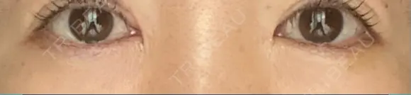 リジュラン 湘南美容クリニック 岡山院 AFTER メイン用