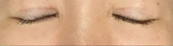 リジュラン 湘南美容クリニック 岡山院 DAY 8 メイン用