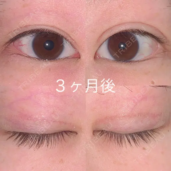 二重切開 / 上まぶたの脂肪取り 湘南美容クリニック 宇都宮院 AFTER メイン用