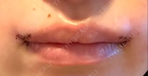 口角挙上 くさのたろうクリニック DAY 1 メイン用