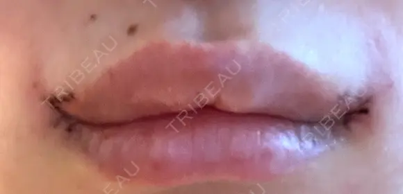 口角挙上 くさのたろうクリニック DAY 2 メイン用