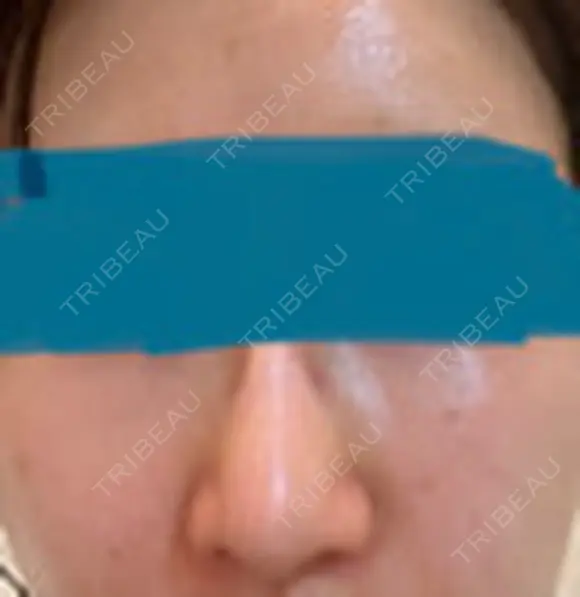 ピーリング（ハリ・ツヤ） まゆりなclinic 名古屋栄 DAY 4 メイン用