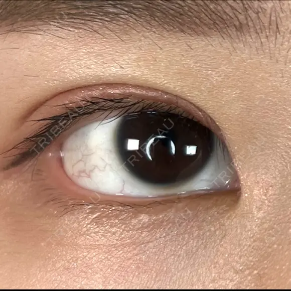 二重埋没 ALMOND CLINIC AFTER メイン用
