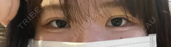 二重埋没 もとび美容外科クリニック 新宿院 AFTER メイン用