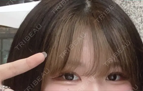 二重埋没 もとび美容外科クリニック 新宿院 DAY 33 メイン用