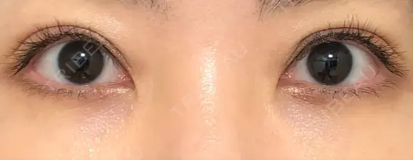 二重切開 / 眼瞼下垂（切開） / 目元修正 トップフェイス整形外科 AFTER メイン用