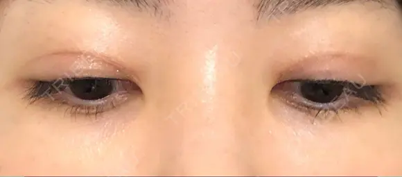 二重切開 / 眼瞼下垂（切開） / 目元修正 トップフェイス整形外科 DAY 129 メイン用