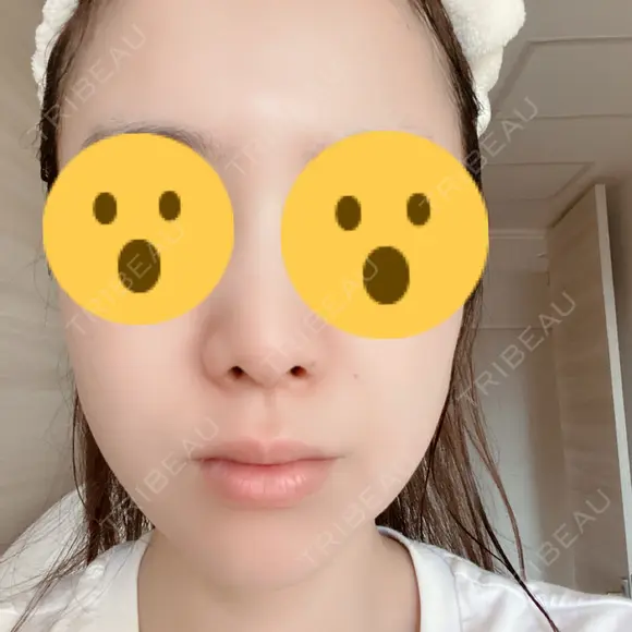 ハイフ（顔） 新宿中央クリニック DAY 1 メイン用