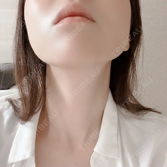 ハイフ（顔） 新宿中央クリニック AFTER メイン用