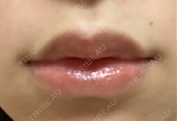口唇縮小術 B-LINE CLINIC 池袋院 AFTER メイン用