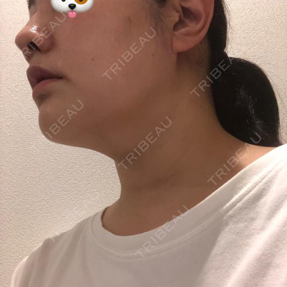 ハイフ（顔） オーキッド美容クリニック東京御徒町 DAY 0 メイン用