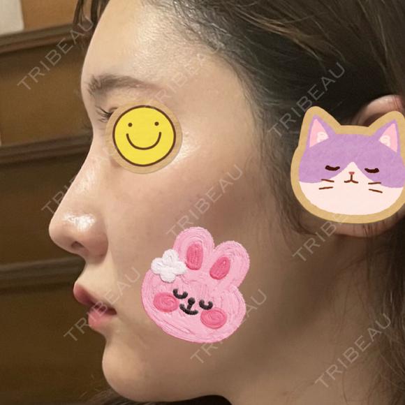隆鼻術 / 鼻尖形成（切開） / 鼻中隔延長（切開） / 小鼻縮小（切開） / プロテーゼ除去 / 鼻尖縮小 FROM B整形外科 (旧バウム整形外科) AFTER メイン用