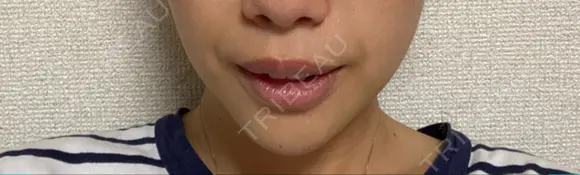 あごプロテーゼ エースクリニック 名古屋院 DAY 10 メイン用