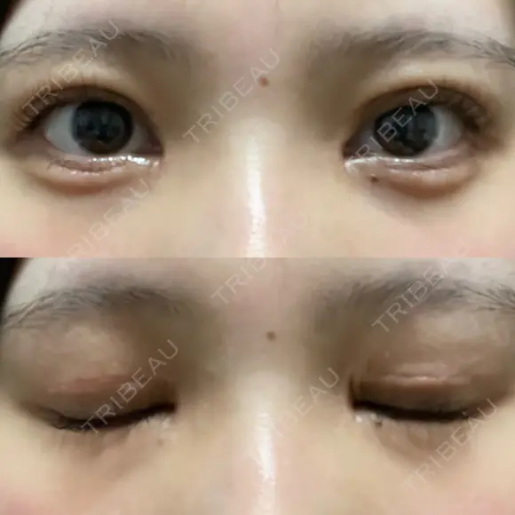 二重切開 / 目頭切開 / クマ治療 / 上まぶたの脂肪取り / 下まぶたの脂肪取り / タレ目形成・グラマラスライン（切開） BRIGHTS beauty clinic DAY 36 メイン用