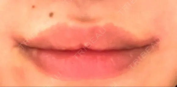 口角挙上 くさのたろうクリニック DAY 6 メイン用