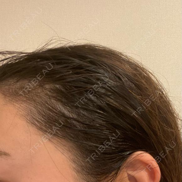 アートメイク（ヘアライン） トイトイトイクリニック 池袋院 DAY 8 メイン用