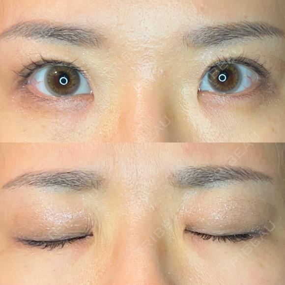 二重埋没 東京ベレッザクリニック AFTER メイン用
