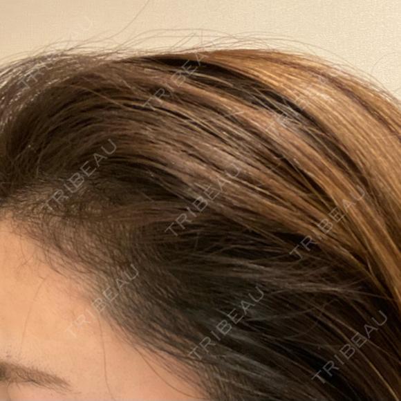 アートメイク（ヘアライン） トイトイトイクリニック 池袋院 DAY 9 メイン用